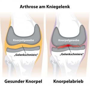 Ratgeber: Operation ist oftmals überflüssig Konservative Behandlung