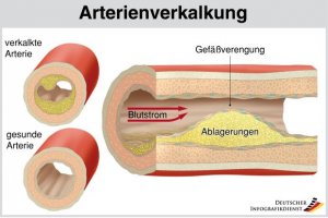 Aktuelles: Gute Pflege für die Gefäße - Verkalkungen und Durchblutungsstörungen 