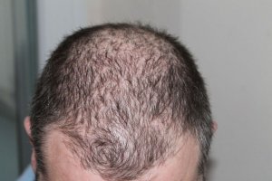 Ratgeber: Was hilft gegen Haarausfall?