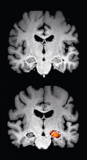 Aktuelles: Bei Angst vor Alzheimer kann rasche Abklärung Erleichterung bringen