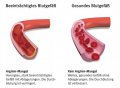 Aktuelles: Zu viel Druck in den Gefäßen - Gefahr fürs Herz