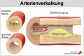 Aktuelles: Gute Pflege für die Gefäße - Verkalkungen und Durchblutungsstörungen 