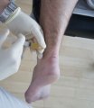 Aktuelles: Schnellere Heilung bei Verletzungen der Achillessehne