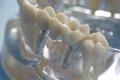 Aktuelles: Bis auf die Knochen gefestigt! Knochenaufbau bei Zahnimplantaten
