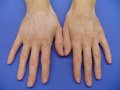 Ratgeber: Internationales Vitiligo-Zentrum hilft Patienten aus der ganzen Welt
